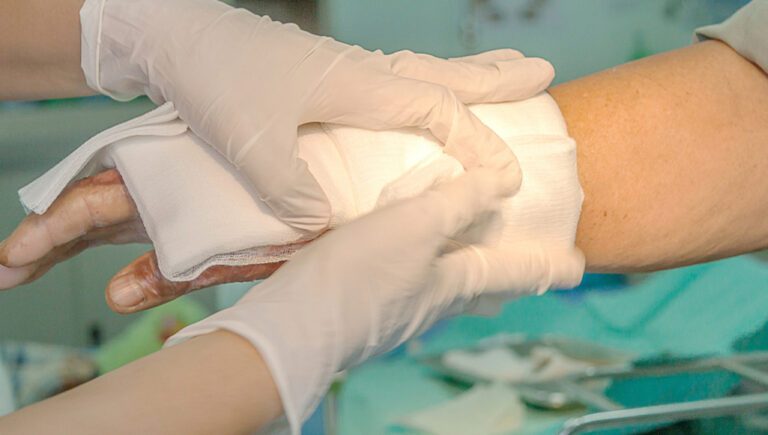 পুড়ে গেলে প্রথমেই যে চিকিৎসা নেবেন