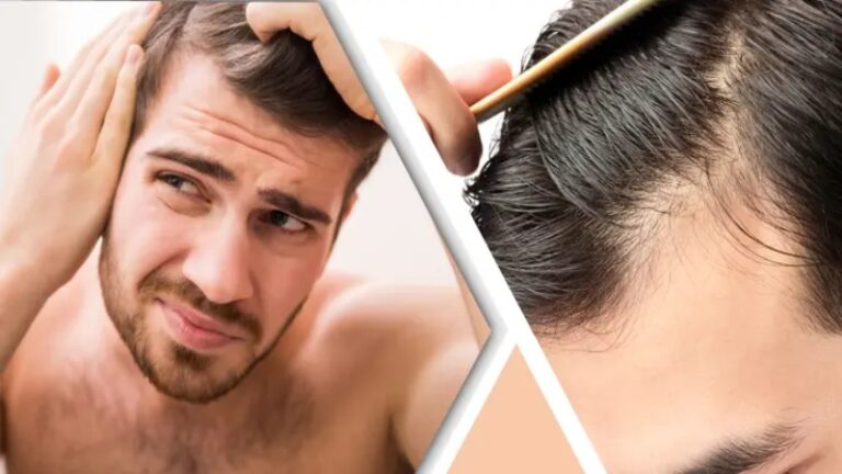 চুল পড়া বন্ধ করতে চান? জেনে নিন পুরুষদের জন্য সবচেয়ে বড় ৫টি ঝুঁকিপূর্ণ অভ্যাস