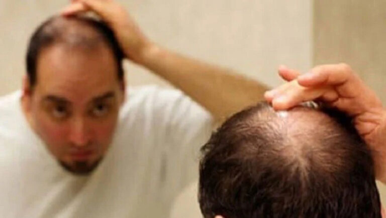 অল্প বয়সে চুল পড়ার কারণ ও চিকিৎসা